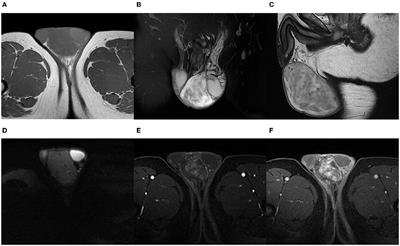 Case Report: Magnetic Resonance Imaging Features of Scrotal Angiomyofibroblastoma (AMF) With Pathologic Correlation